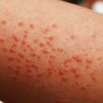 Morelos detecta 13 casos importados de sarampión; suman 5 mil a nivel nacional